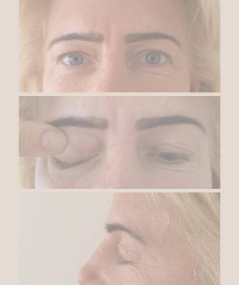 galeria korekcja powiek kobieta przed operacja powiek zwana blefaroplastyka