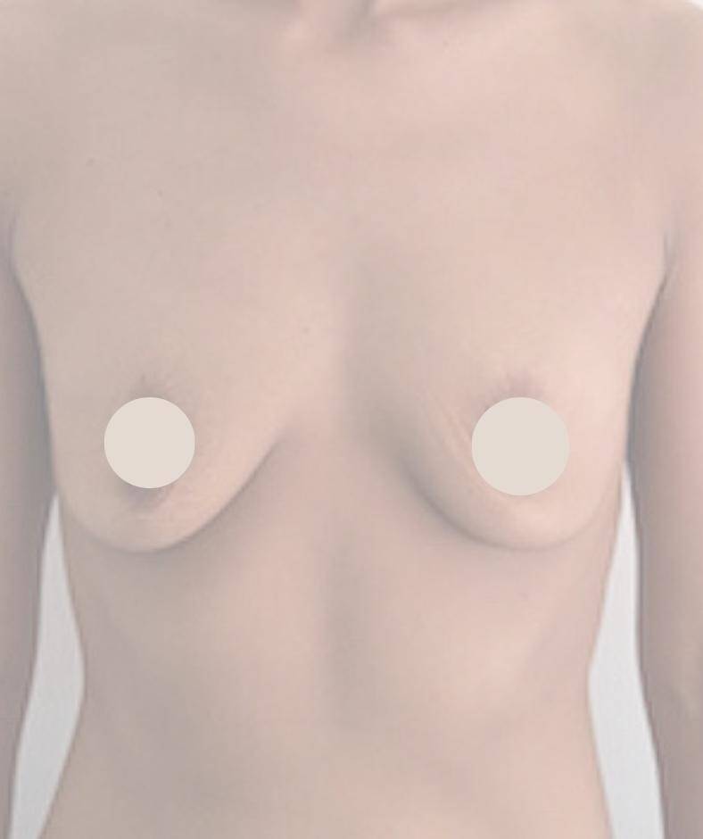 ułów kobiety powiekszenie piersi implantami - p.1