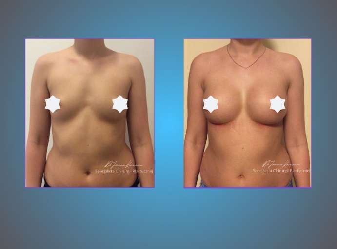 pacjentka przed i po powiększanie piersi, implanty piersi, powiększanie piersi, powiększanie biustu bez kwas hialuronowy