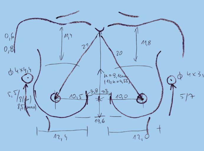 konsultacja przed operacją plastycznej powiększania piersi