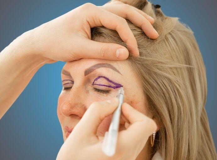 dr Kurmanow Poznań rysuje na powiece linie cięć i rozważa czy pacjentka nie ma przeciwskazań do plastyka powiek