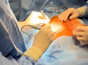 operacja powększania piersi/powiększania biustu w Poznaniu